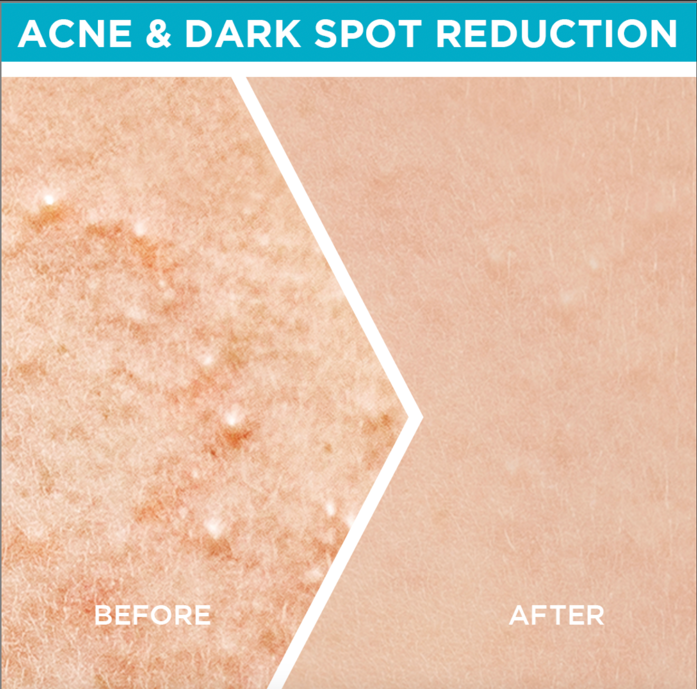Bundle - Garnier Fast Clear Serum for Acne Prone Skin - 30ml + Free Face Serum Massager