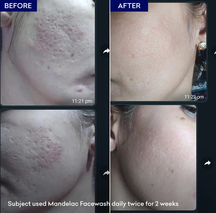 Jenpharm Mandelac Face Wash 100Ml