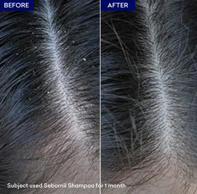 Jenpharm Sebornil Anti Dandruff Shampoo 100Ml