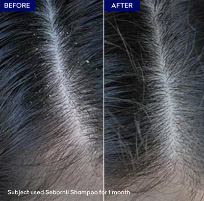 Jenpharm Sebornil Anti Dandruff Shampoo 100Ml