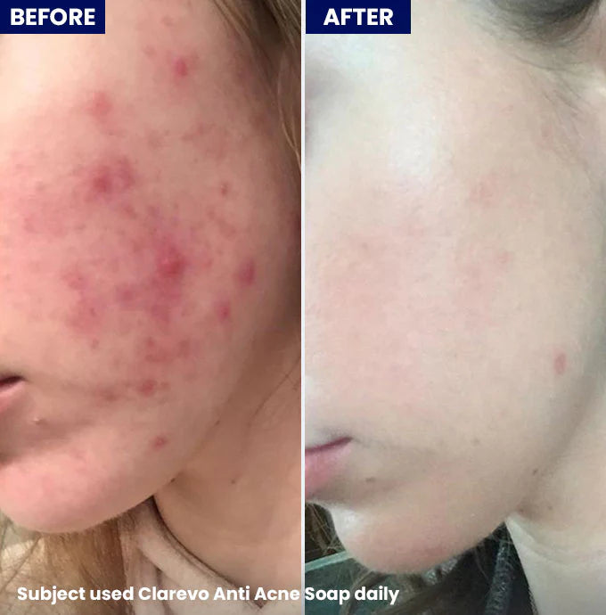 Jenpharm - Clarevo anti-acne soap