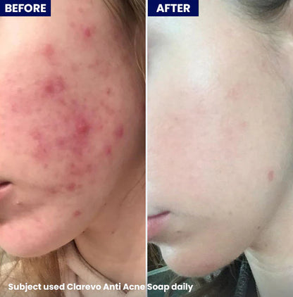 Jenpharm - Clarevo anti-acne soap