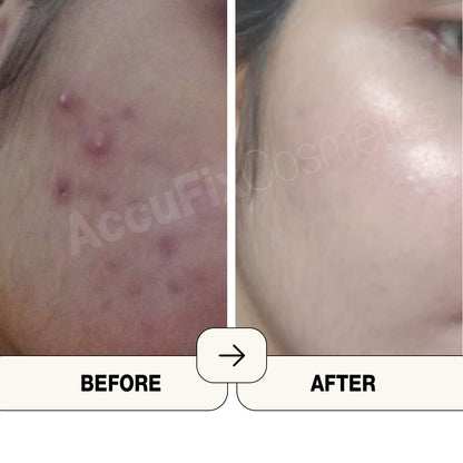 AccuFix - Salicylic Acid Serum | BHA Serum