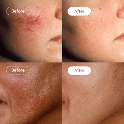 Azelaic acid serum Before & After | AccuFix Cosmetics