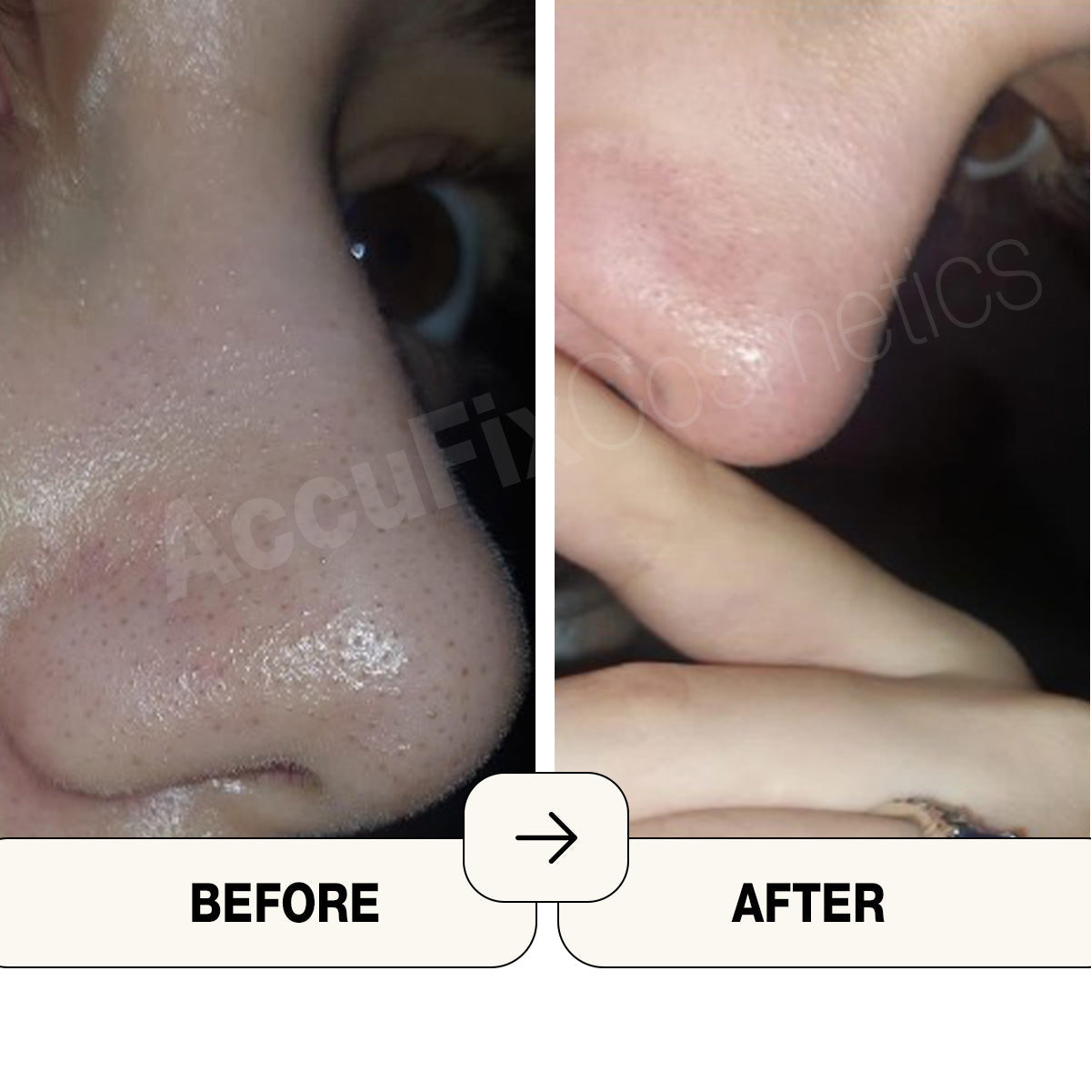 Before and after result of using salicylic acid cream