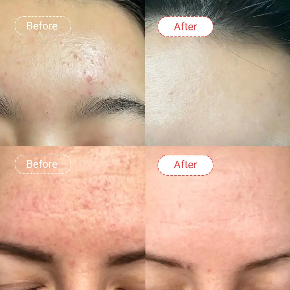 Salicylic Acid Serum Before & After | AccuFix Cosmetics