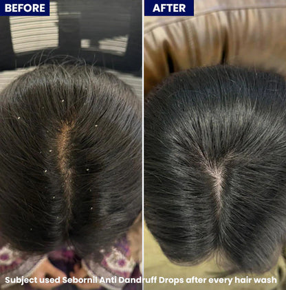 Jenpharm - Sebornil Anti-Dandruff Drops