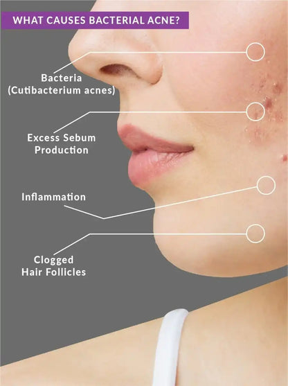 Beautenic - Benzoyl Peroxide Acne Treatment Toner
