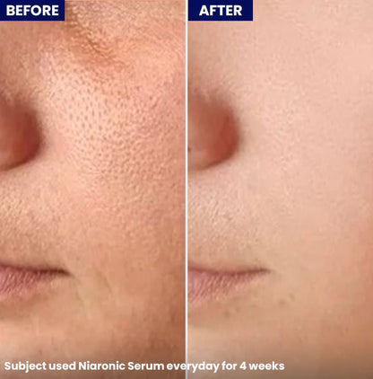 Jenpharm Niaronic Acne Control Serum Vitamin B3 30Ml