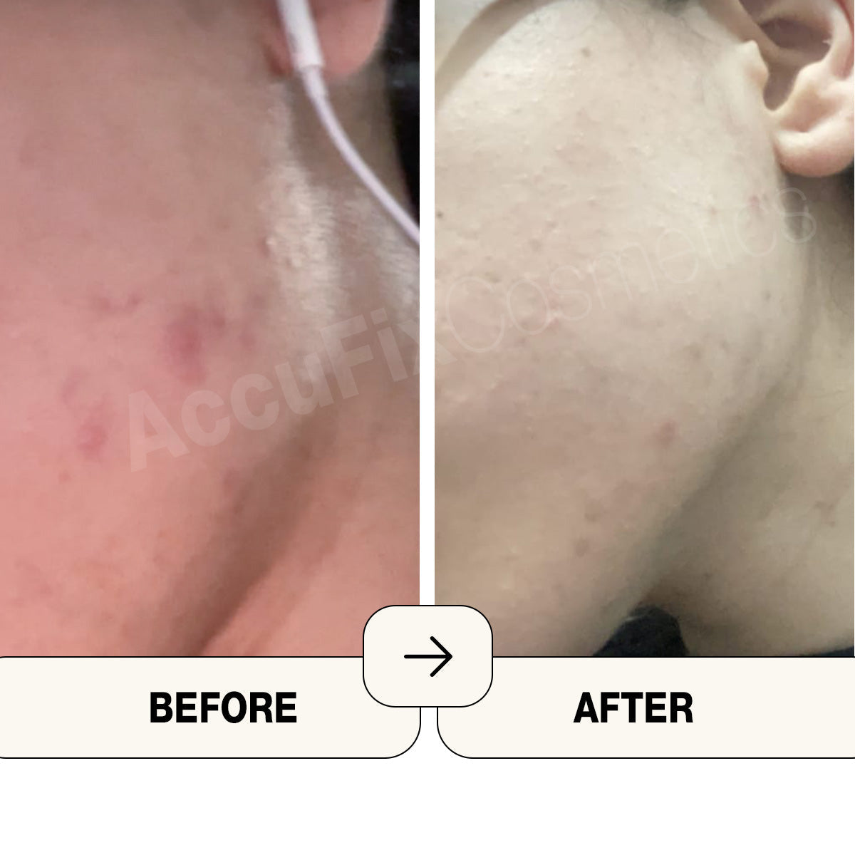 Review of AccuFix Salicylic acid face wash